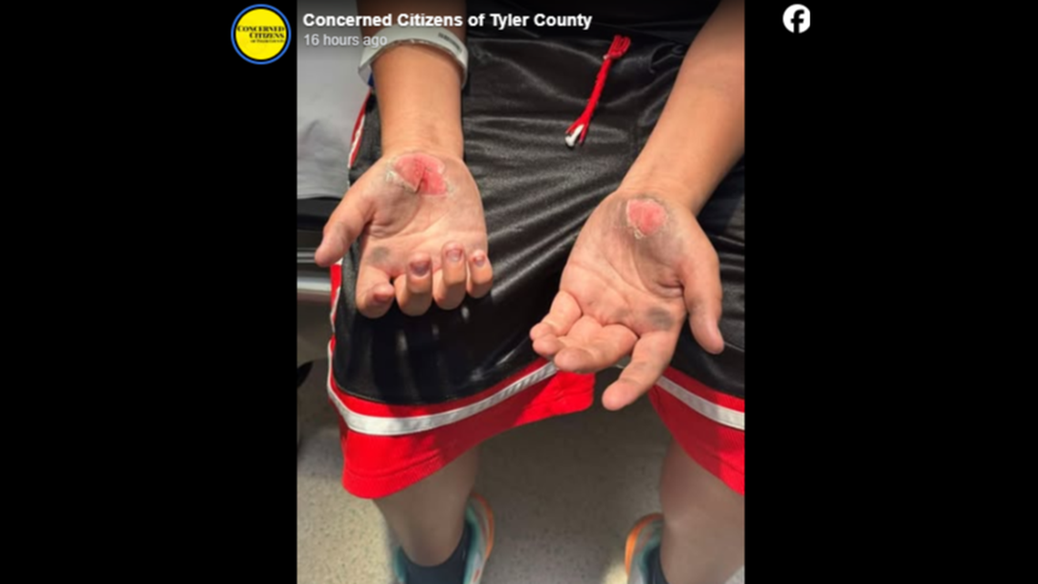 A middle school student shows burns suffered from doing bear crawls on a school track in Woodville, Texas.