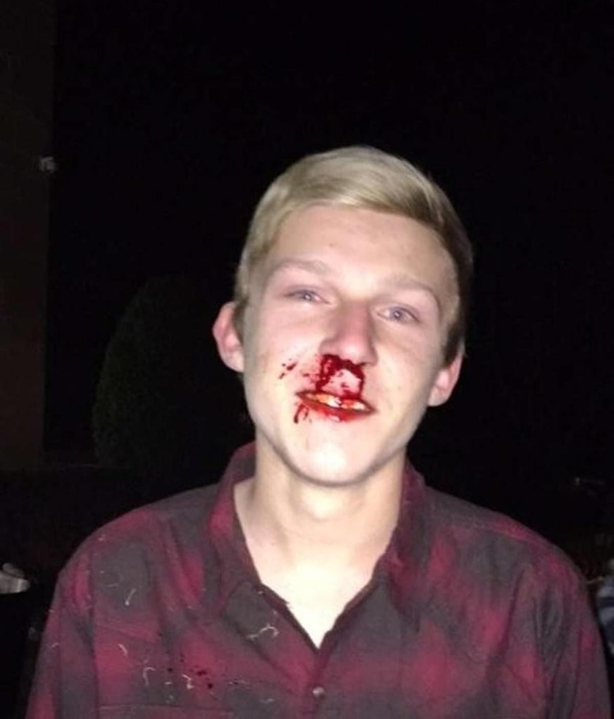 Blake Novacek suffered a broken nose in an earlier “fight club” hazing incident, according to his attorney.