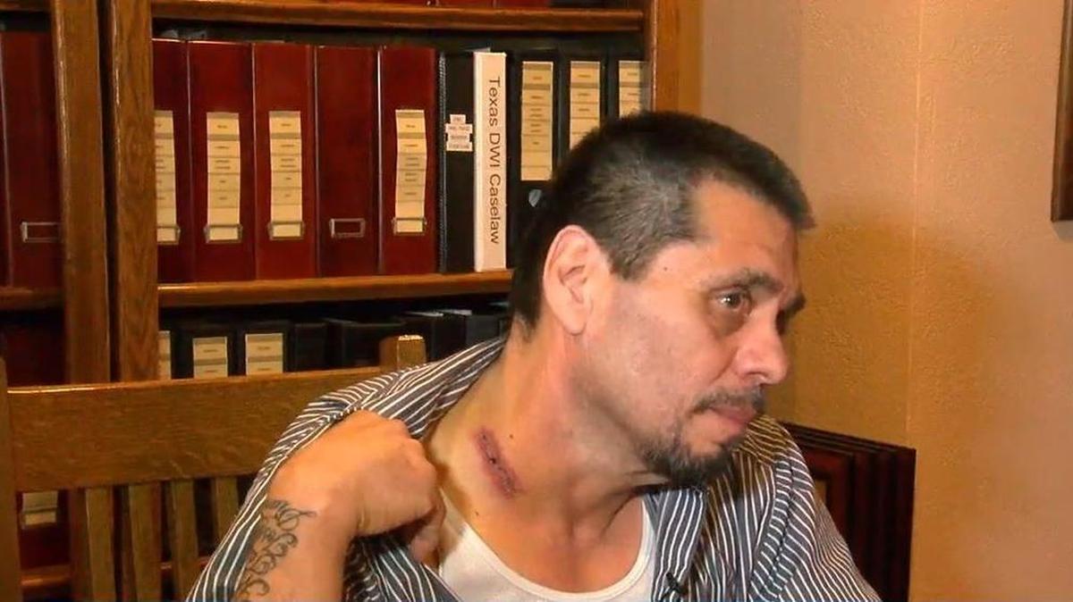 Tony Garces shows one of his wounds after being shot twice by Amarillo police.