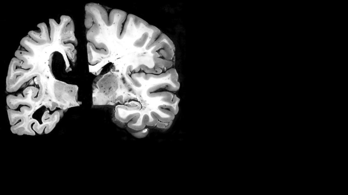 
A brain slice of a 70-year-old brain with Alzheimer's disease, left, and a normal 70-year-old brain at right. 
