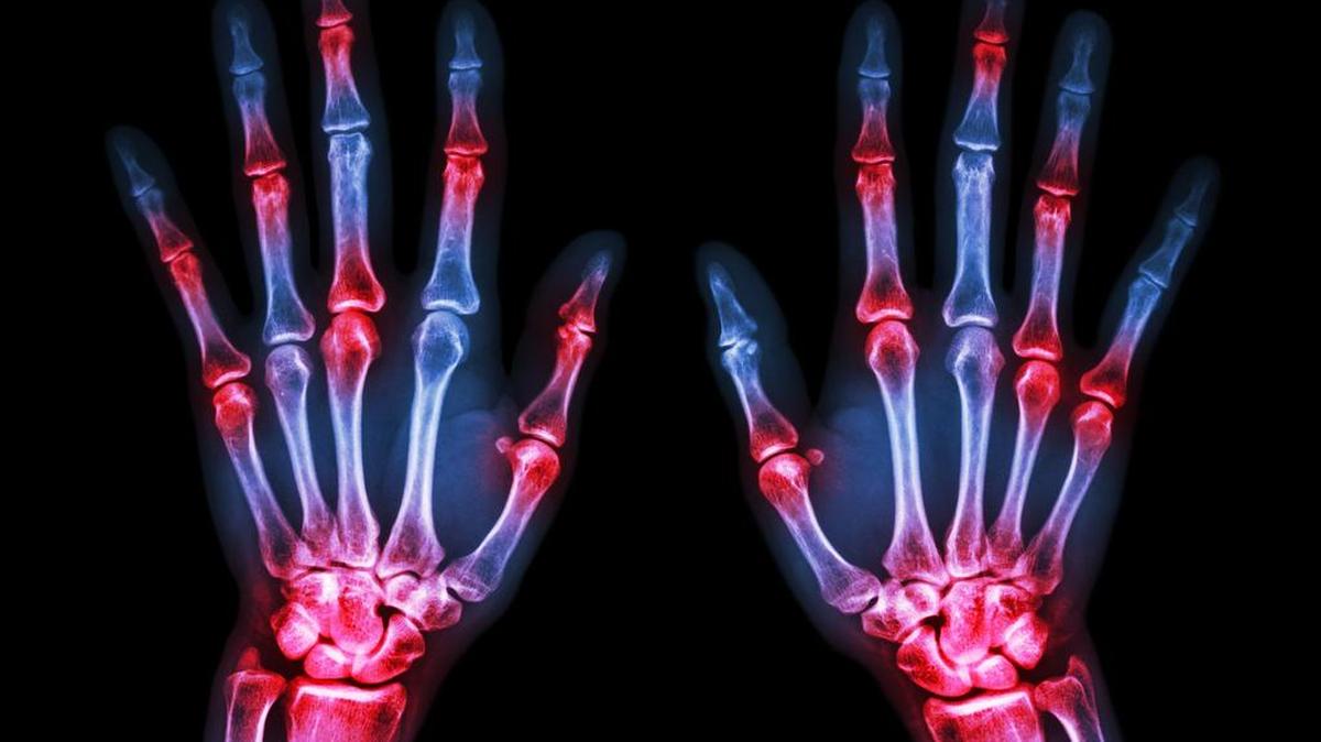 X-rays of both human's hands and arthritis at multiple joints.