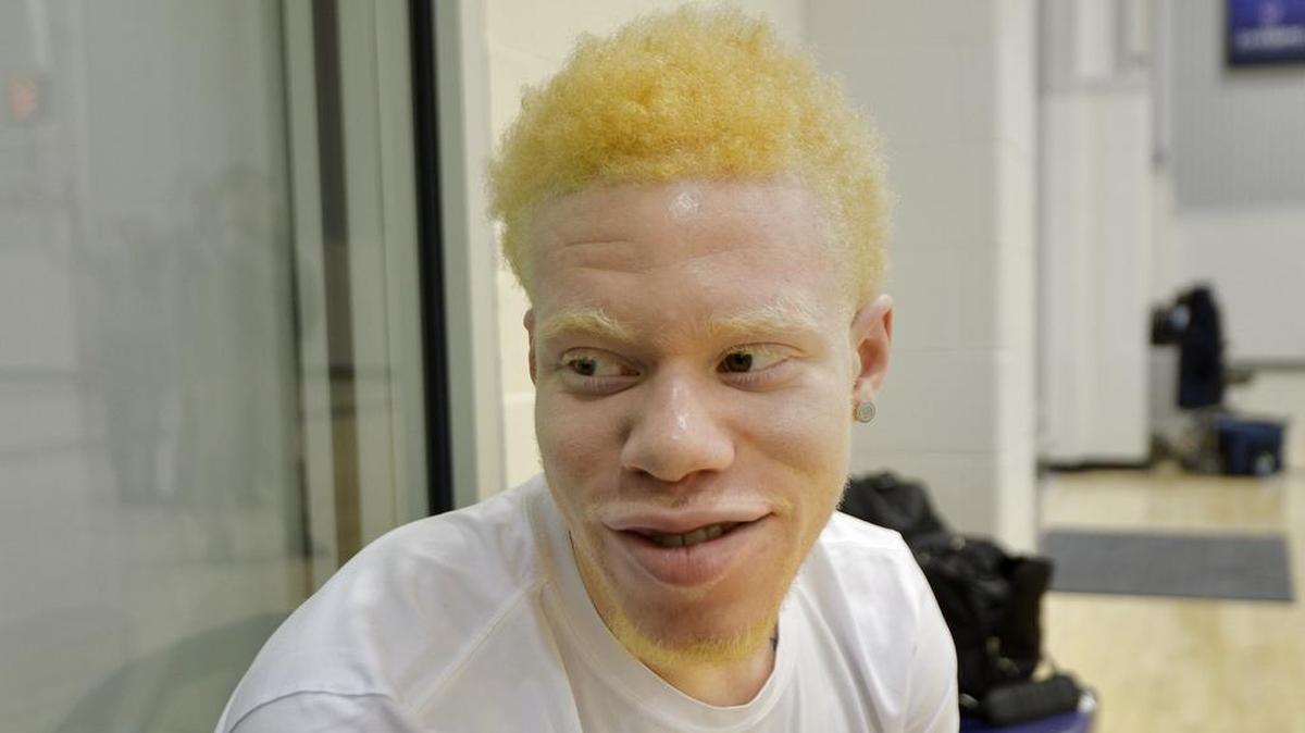 TCU point guard Jaylen Fisher says he first became aware that he had albinism when he was 5 or 6.